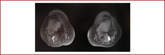 図2　両側骨梗塞（大腿骨、近位脛骨）が同定された症例のMRI像（37歳、女性、PNH）
