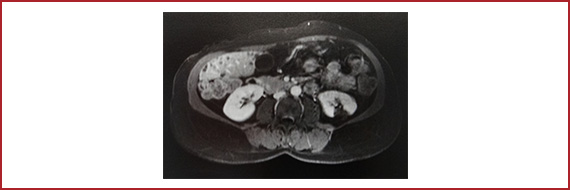 図1　両側腎梗塞が同定された症例のMRI像（51歳、女性、PNH）